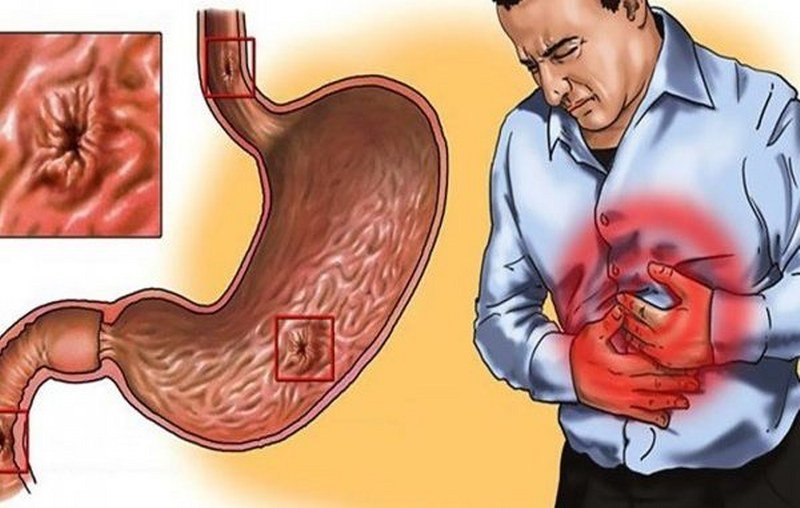 Muči li vas gastritis i bol u želucu? Uzimajte ovaj lijek i riješite ga se za tri dana