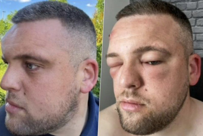 -Nešto mi je iskočilo iz čela i počelo da se koprca- Mislio je da je bubuljica, cijedio ju je...