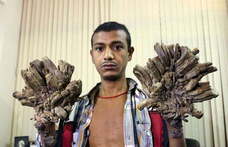 Izlečen "Čovek drvo" iz Bangladeša?