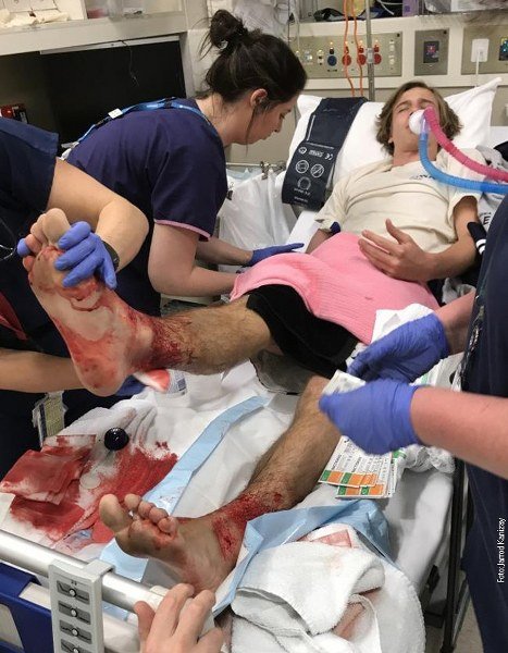 Tinejdžer u bolnici posle napada morskih vaški!