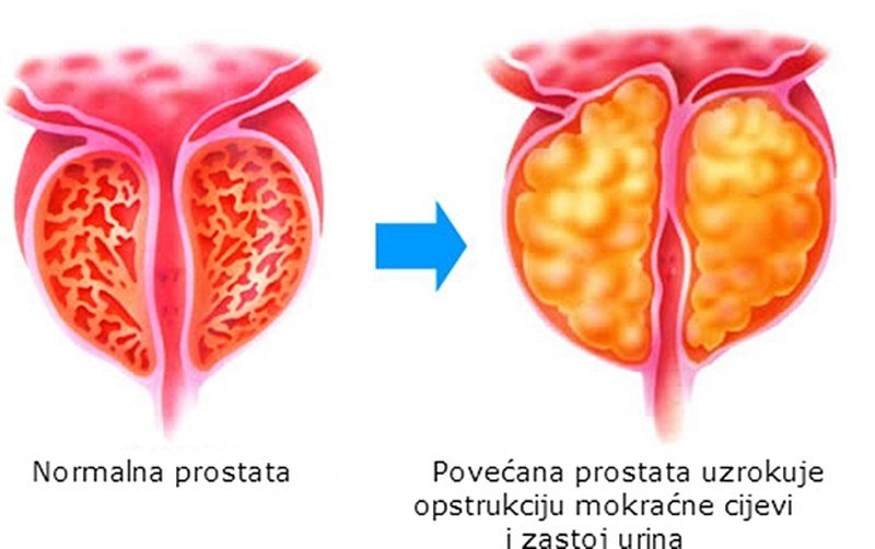 Nema boljeg: Najbolji lijek za prostatu na svijetu!